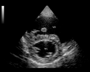 Un cas de Dirofilariose compliquée d’un syndrome de la veine cave