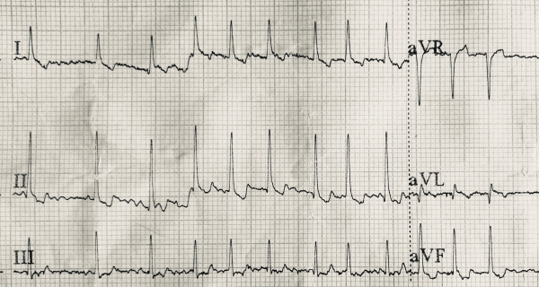 fig 1 : ECG