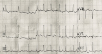 Hypothyroïdie et fibrillation atriale